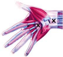 How do you know if you have Carpal Tunnel Syndrome?
