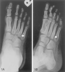 Case Report 71 An Intraosseous Capillary Hemagioma Of The Foot In A Child Kah-Wai Ngan, MD; Hui-Ling Hsu 1, MD; Shir-Hwa Ueng, MD An 8-year-old boy presented with an osteolytic lesion at the fourth