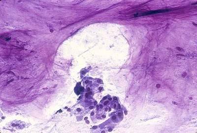 Faquin - Salivary Gland FNA, 2010 9 metaplasia (mucus retention cyst) in sialolithiasis, mucinous metaplasia in Warthin tumor or pleomorphic adenoma, and low-grade mucoepidermoid carcinoma.