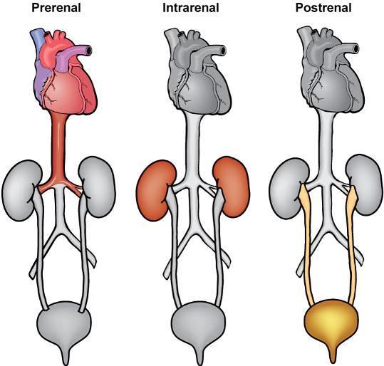 Types of Acute Kidney Injury 1. PRERENAL Impaired renal perfusion (shock, hypovolemia, volume shifts, CO, PVR(pulmonary vascular resistance), renal artery obstruction) 2.