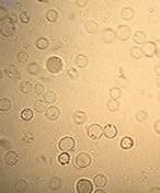 Red Blood Cells Monomorphic (nondysmorphic) RBC suggest non-glomerular source