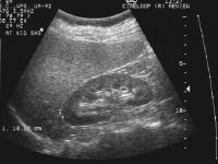 AKI: Ultrasound Findings