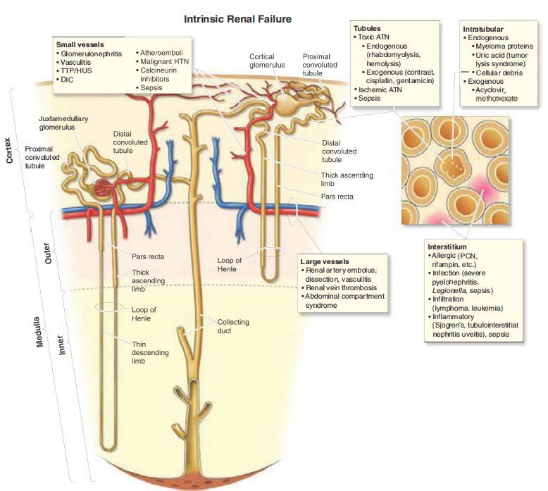 AKI: Renal or Intrinsic The most common causes of intrinsic AKI
