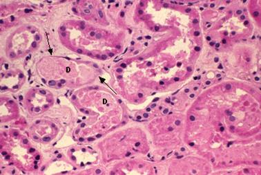 Acute Tubular Necrosis Acute tubular necrosis showing focal loss of tubular epithelial cells (arrows) and partial