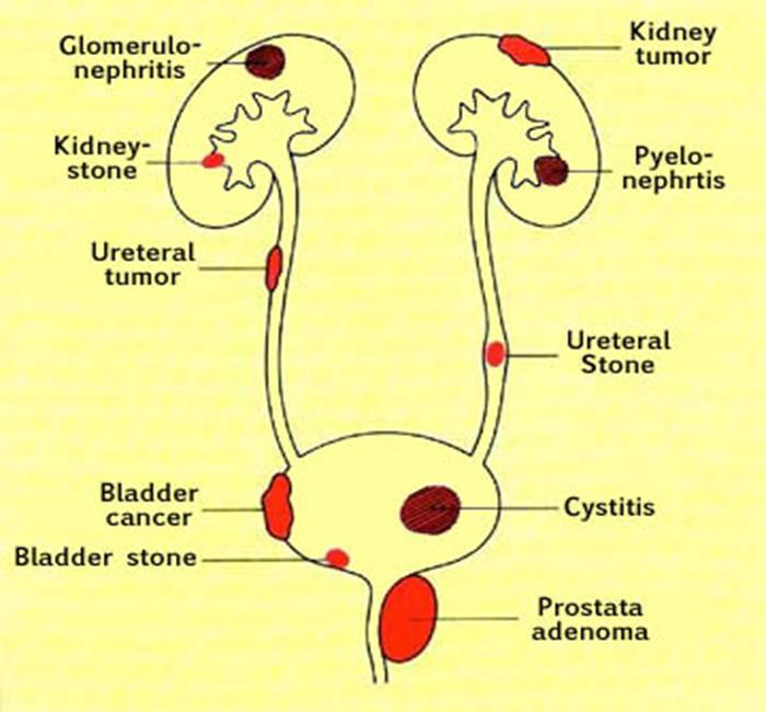 Acute Kidney Injury: Post-renal Intra-renal Obstruction Acute uric acid nephropathy Drugs