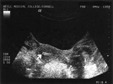 Ultrasound markers of ovarian reserve Modena April 18-19, 2008 Frank J Broekmans Reproductive Medicine UMC Utrecht Impact study: