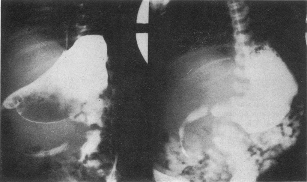 122 Kobayashi and Ohbe Fig. 1 Case 1. Contrast studies of upper gastrointestinal tract showing enlarged duodenal C-loop. Fig. 2 Case 1. Cyst shown by operative cholangiography.