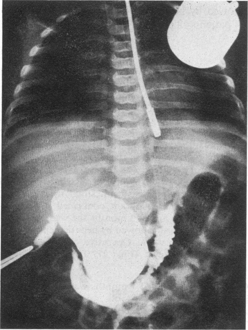 Barium meal showed a markedly displaced duodenum anteriorly and inferiorly (Fig. 3a, b).