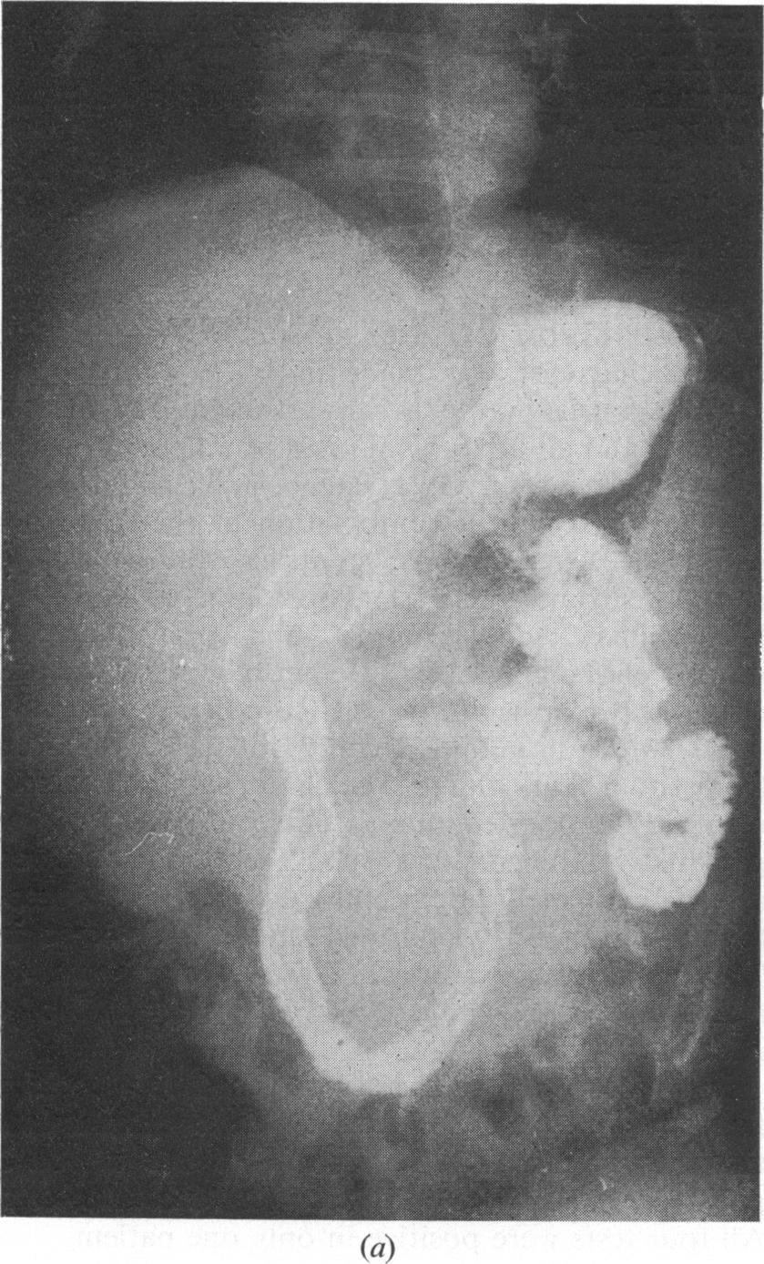 Choledochal cyst in infancy and childhood: analysis of 16 cases 123 (b) Fig. 3 Case 3. Barium meal showed marked anterior and inferior displacement of duodenum.