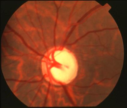 Clinical Challenges To identify patients with risk factors for possible glaucoma.