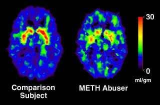 Positron Emission Tomography PET Scan Measures how much of a chemical the