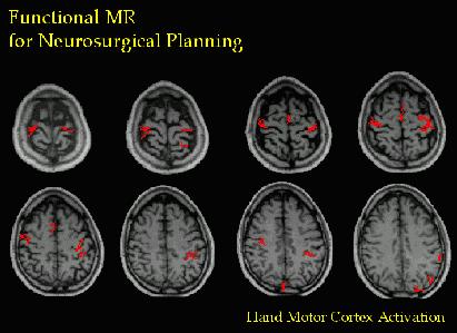 Functional MRI Combination of PET and