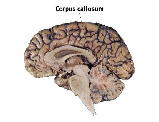 The Corpus Callosum Divides the 2 hemispheres. Divides the left from right sides.