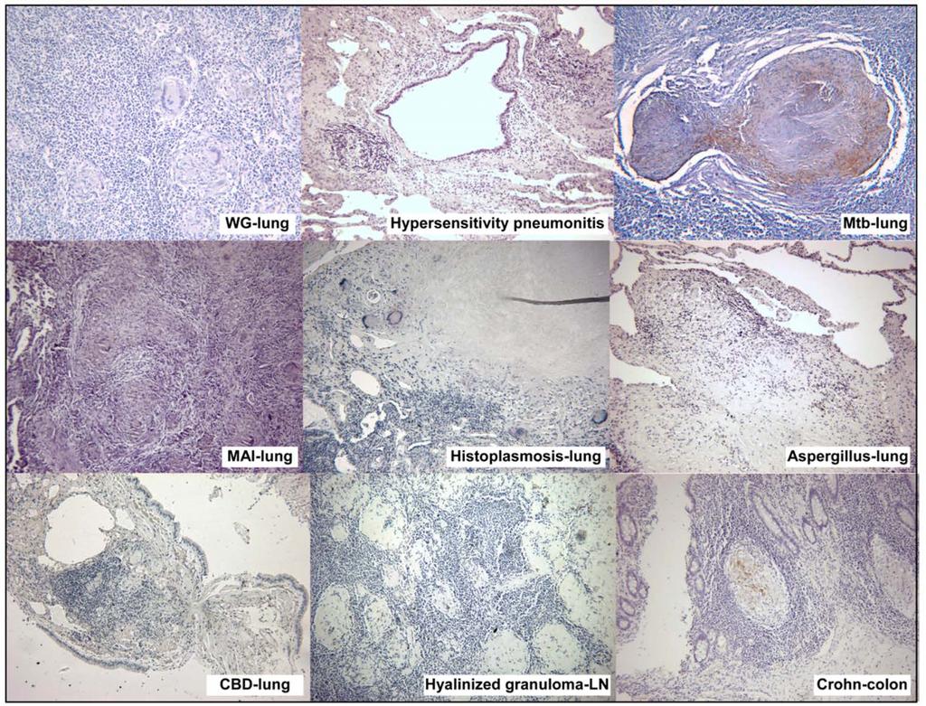 SAA is highly expressed in granulomas in sarcoidosis Chen ES et al. AJRCCM 2010.