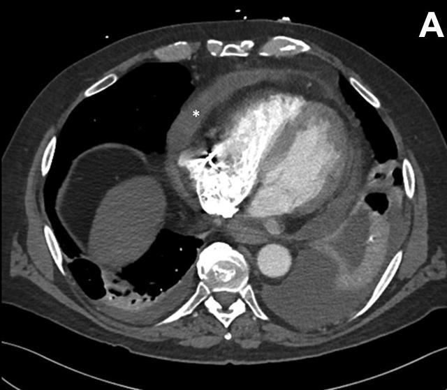 Pericardial effusion in CT