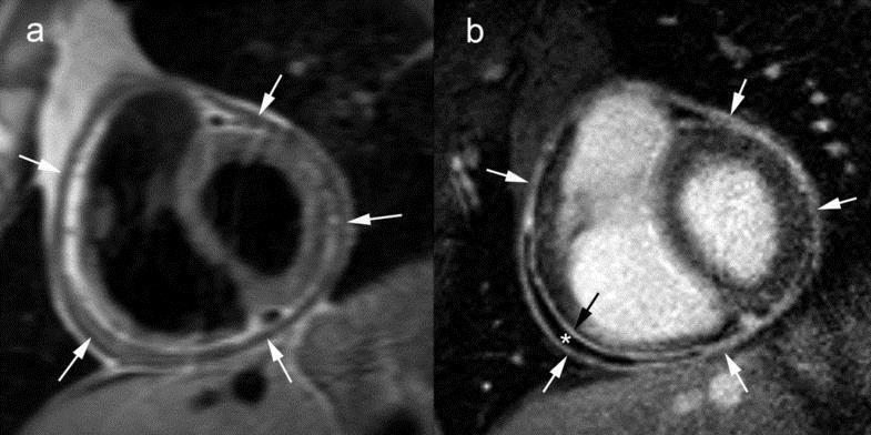 Constrictive pericarditis in MR Short-axis T1- weighted spin-echo CMR LGE CMR Diffusely