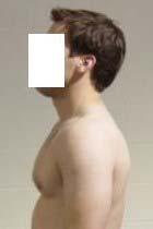 Forward head posture Shortened Muscles Suboccipital muscles strenocleidomastoid Lengthened Muscles Deep cervical flexors (12,13,20,21,24) Potential corrective exercises to address forward head