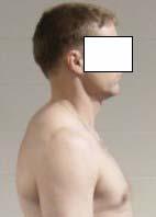 Normal thoracic spine curve Increased thoracic spine curve This distortion of posture which includes a forward head, increased thoracic kyphosis, rounded shoulders, and internally rotated upper arms
