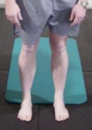 LOWER EXTREMITY ALIGNMENT Lower extremity alignment tends to follow that of the pelvis in predictable patterns.
