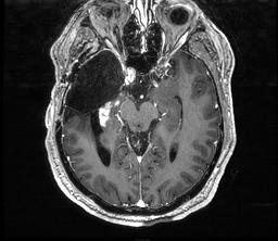 161 62 year old male with recurrent GBM of right temporal lobe Prior therapy: surgical resection, radiation therapy, and temozolomide The regimen induced disappearance