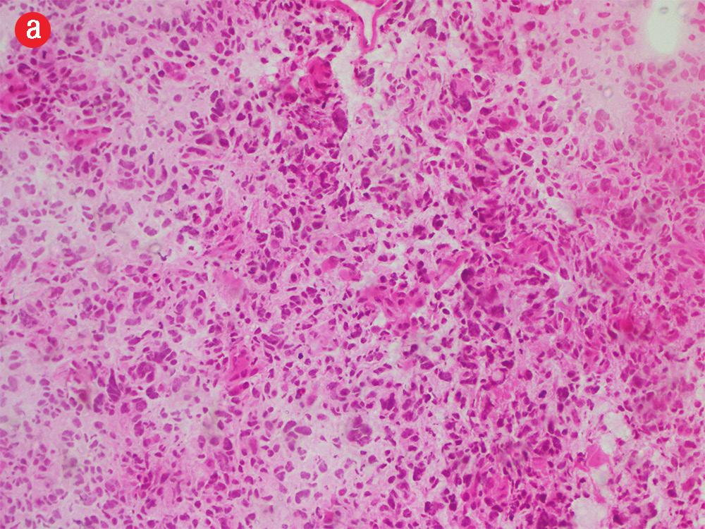 papilloma with H&E staining, magnification = 200.