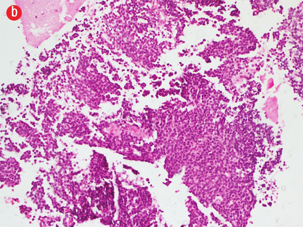 medulloblastoma with H&E staining, magnification = 200.