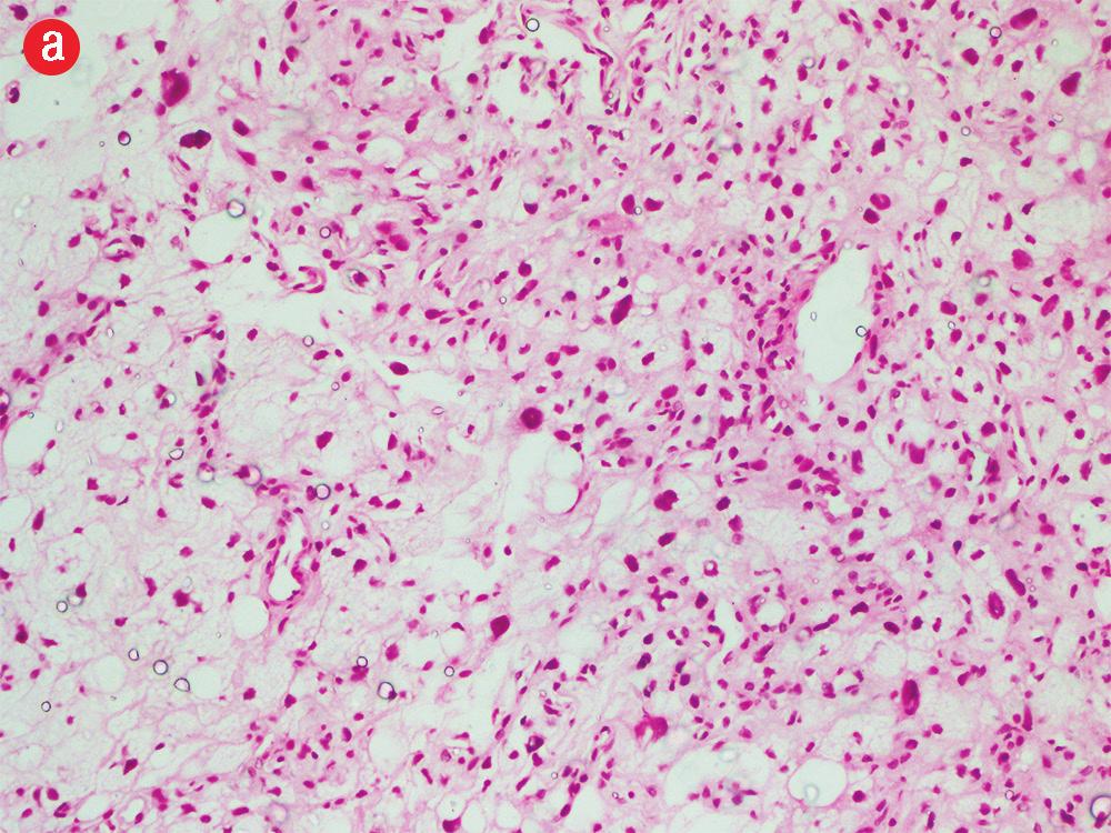 48 R adiya A l-a jmi, et al. Figure 4: (a) Frozen section diagnosed as low-grade glioma favoring ependymoma with hematoxylin and eosin (H&E) staining, magnification = 200.