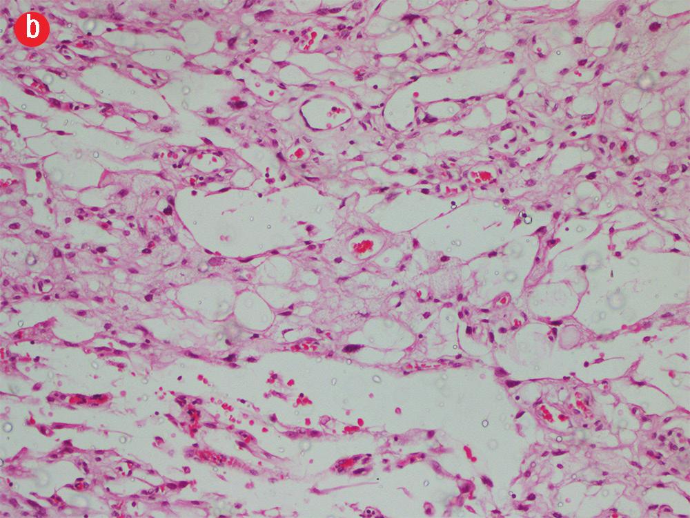Figure 5: (a) Frozen section diagnosed as a malignant neoplasm with hematoxylin and eosin (H&E) staining, magnification = 200.