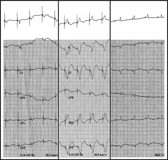 ADVANCED ICD TROUBLESHOOTING Figure 12. QRS morphology during biventricular pacing.