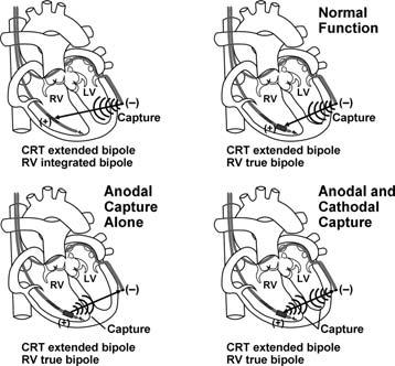 SWERDLOW AND FRIEDMAN Figure 13. Possible modes of anodal capture during biventricular pacing. In all examples, an extended bipole paces between LV and RV leads.
