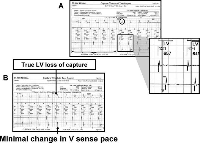 ADVANCED ICD TROUBLESHOOTING Figure 14. Anodal capture during testing of LV capture threshold. LV pacing occurs between a LV cathode and a RV ring anode.
