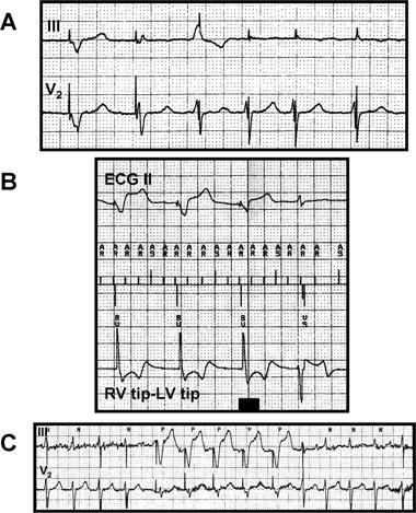 ADVANCED ICD TROUBLESHOOTING Figure 17. Algorithms designed to maintain a high percent of cardiac resynchronization pacing during atrial fibrillation may be confused with inappropriate pacing.