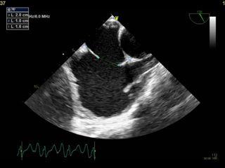echocardiography is insufficient,
