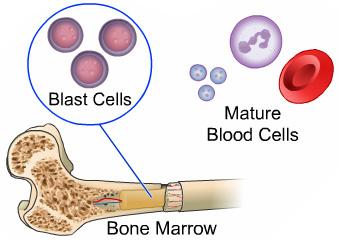 Blood cells are formed in the soft, spongy center of bones called the bone marrow. New, undeveloped blood cells are called blasts.