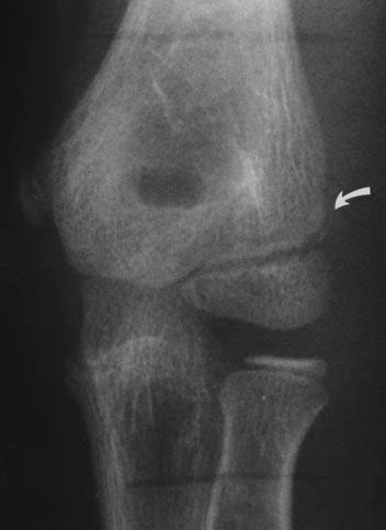 Because the elbow was examined at right angles, coronal imaging of the arm equated to axial imaging of the forearm. Sedation was needed for two children (ages, 2 and 5 years).