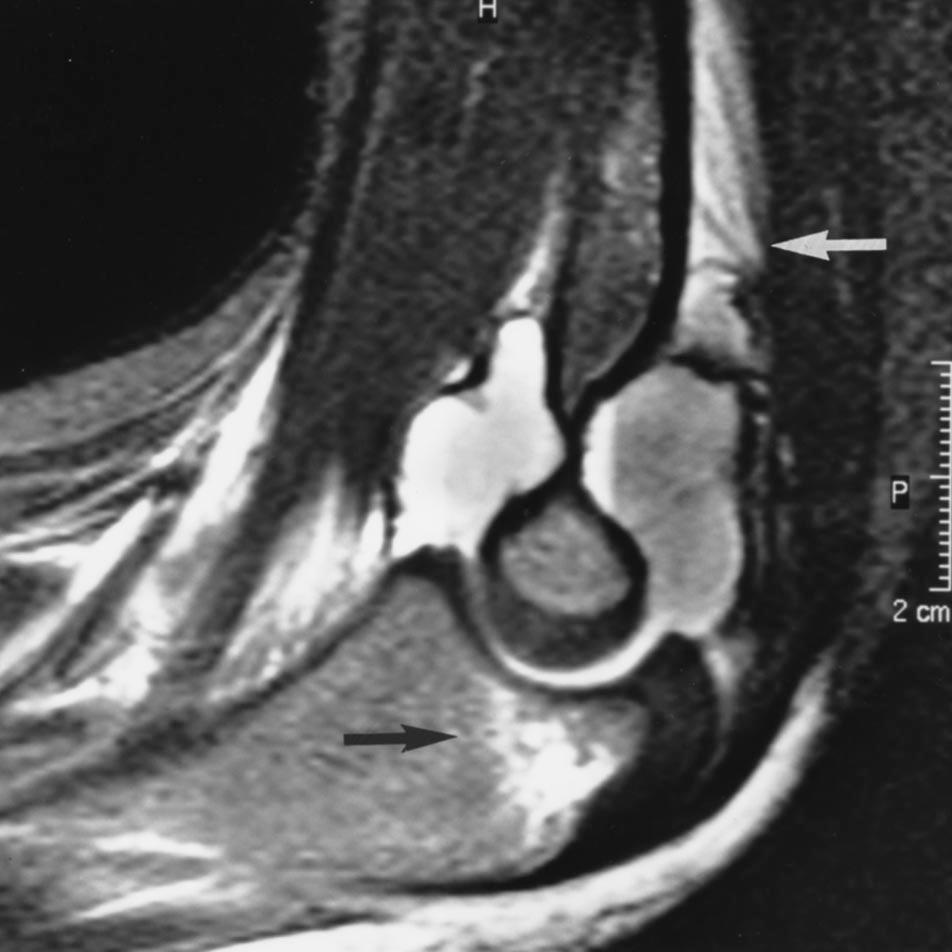 subcutaneous edema. C, Axial T2-weighted STIR MR image of proximal forearm shows fracture (arrow) of radial head. Statistical analysis.