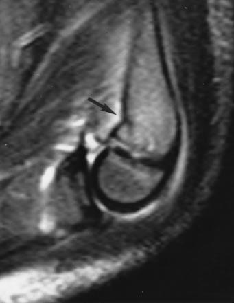 Griffith et al. Fig. 7. 10-year-old boy with elbow injury sustained during fall. Sagittal T2-weighted short tau inversion-recovery MR image of elbow shows edema of brachialis and triceps muscles.