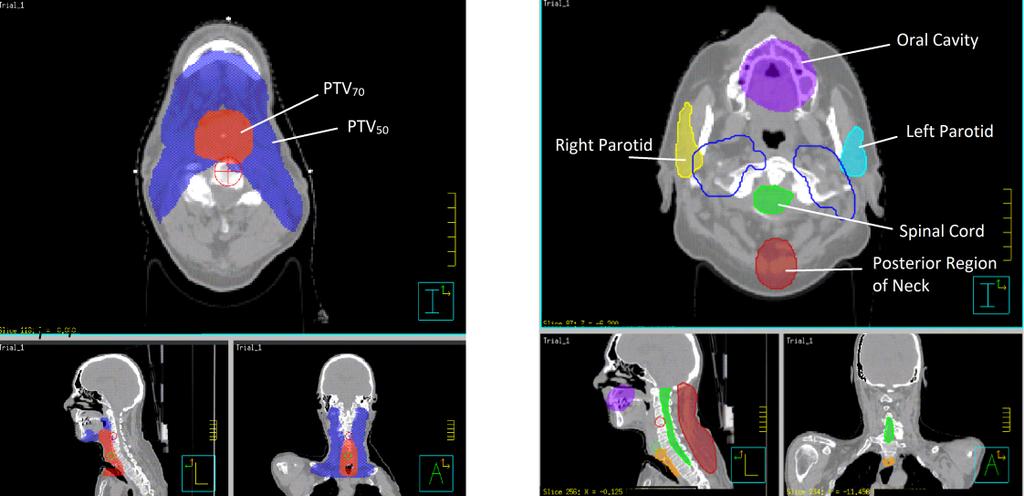 3 A VMAT planning solution for neck cancer patients 403 Fig. 1 Target volumes (a) and organs at risk (b) delineation for larynx cancer in transverse, sagittal and coronal planes.