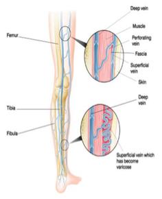 Radiofrequency ablation What are varicose veins?