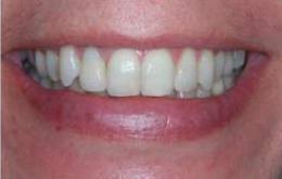 I now can t believe that it is my teeth that I am looking at, they are completely different and lovely and straight. Mrs. Maria The braces you fitted were hardly noticeable.