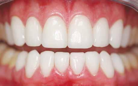 Solution for severely misshapen or crooked teeth without orthodontics: Porcelain Crowns Porcelain crowns may be an option.