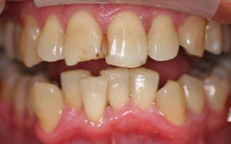 Because of that crowns can be used for severely misshapen, crooked or damaged teeth that cannot be corrected with veneers.