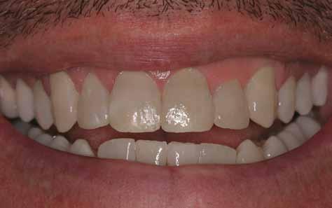 A toothcolored resin material is hardened with a special light,