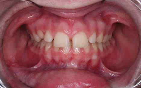 Solution for multiple gaps: Orthodontic Braces Multiple gaps between teeth can be corrected with orthodontic braces.