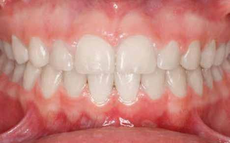 The advantage of braces is that there is nothing artificial that is left attached to the teeth, and therefore if is theoretically healthier.
