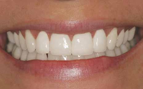 Solution for multiple gaps without orthodontic braces: Porcelain Veneers Porcelain veneers offer a faster way to correct multiple