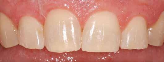 Solution for a small chip: Recontouring If the chip is very small, simple recontouring or polishing can be done to correct the chip and to make the tooth look like a tooth next to it.