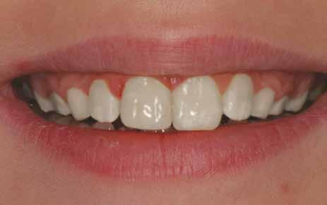 Solution for a bigger tooth chip: Bonding If your tooth chip is a little bigger and