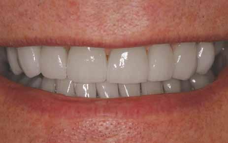 Solution for an extensive chip: Porcelain Veneer A porcelain veneer may be a better option if your chip is
