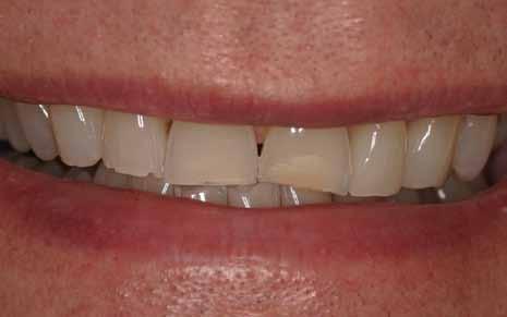 A porcelain veneer is as thin as a contact lens and can be bonded to the tooth with minimal drilling.